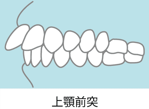 出っ歯（上顎前突）のイメージ画像