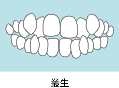乱杭歯・八重歯(叢生)のイメージ画像