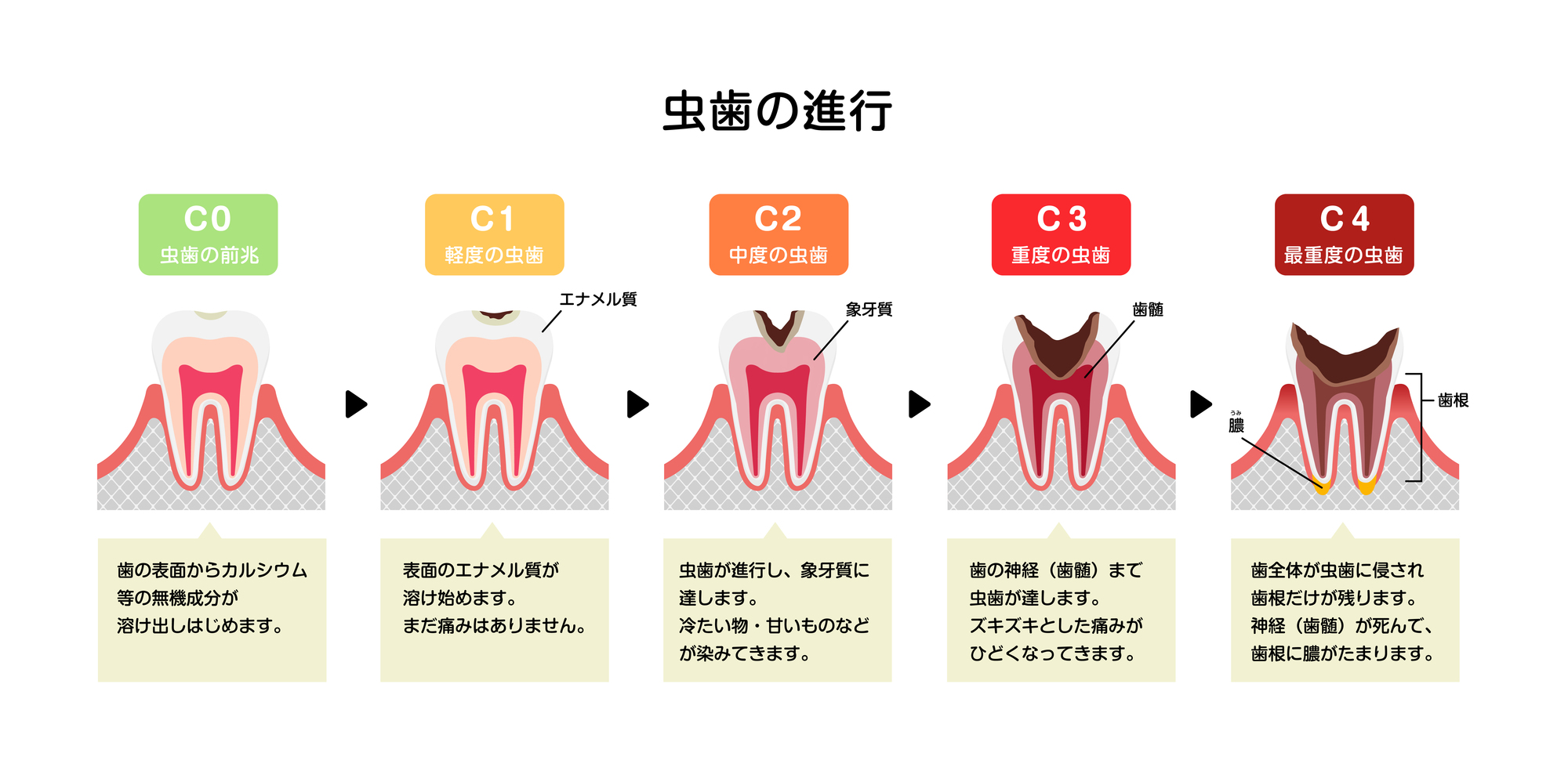 虫歯の進行度│瀬戸市の虫歯治療なら、「瀬戸歯科」削らない、優しい虫歯治療